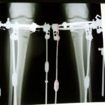 рентген в 24 дня с момента операции