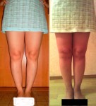 1-2.jpg (111.34 КБ) 5586 просмотров Ножки на сегодня... 10 дней после снятия аппаратов